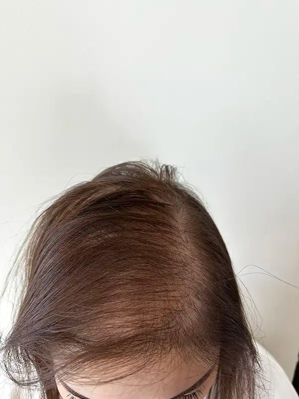 hair thickening before and after