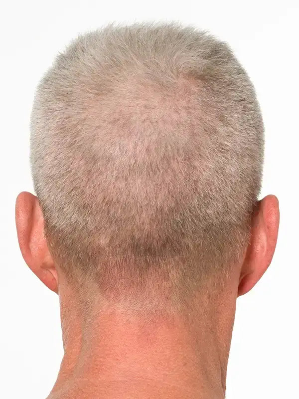 hair regrowth before photo