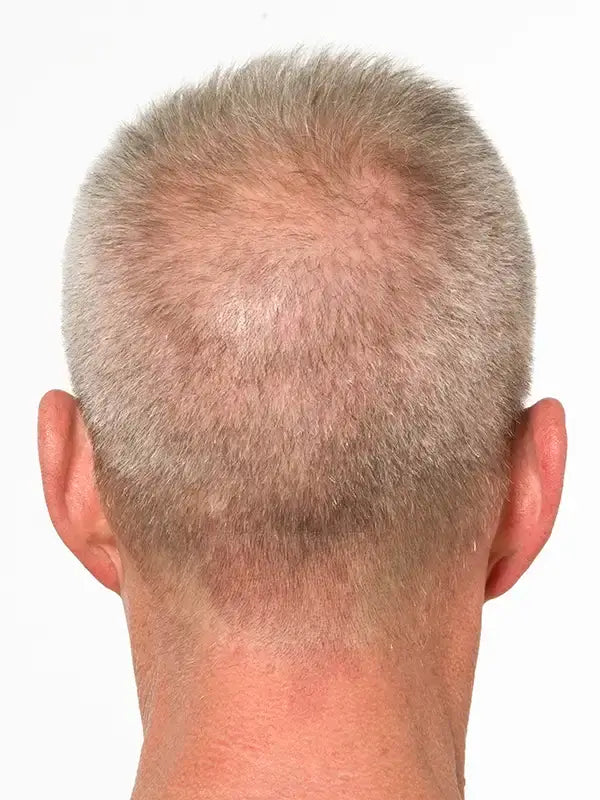 hair regrowth before photo